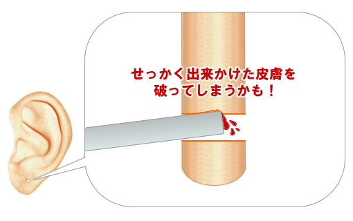 ピアスを病院で開けて１ヶ月 セカンドピアスに交換しても大丈夫